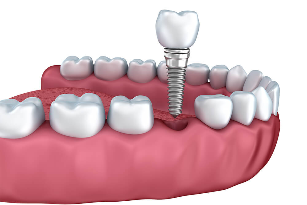 Dental Implants Services in Greenbelt MD Area
